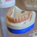 teeth grinding