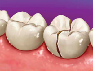 cracked tooth-vertical root structure