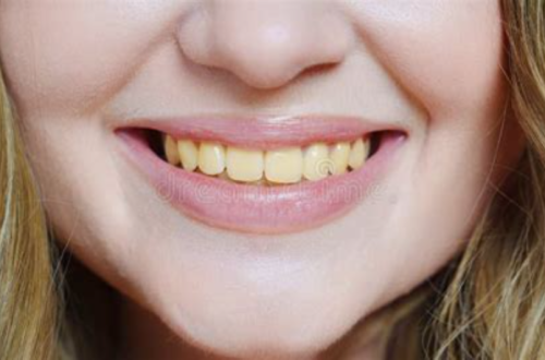 Yellow teeth