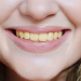 Yellow teeth