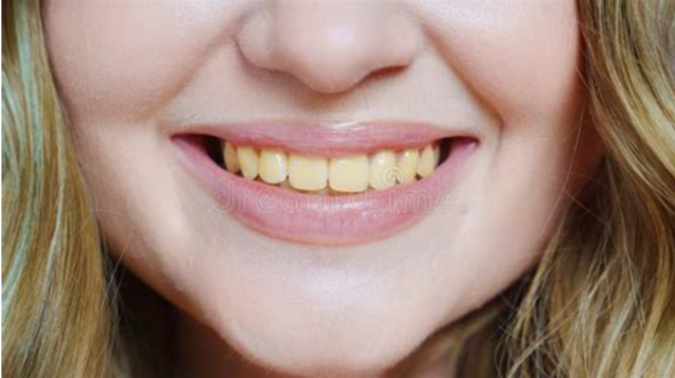 Yellow teeth