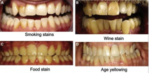 Different yellow teeth