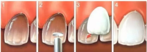 veneer