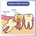 Wisdom-Teeth-Infection