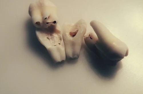 losing my teeth in 20s