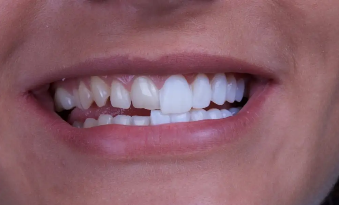 7 Steps to Get Teeth Prepped for Veneers veneer